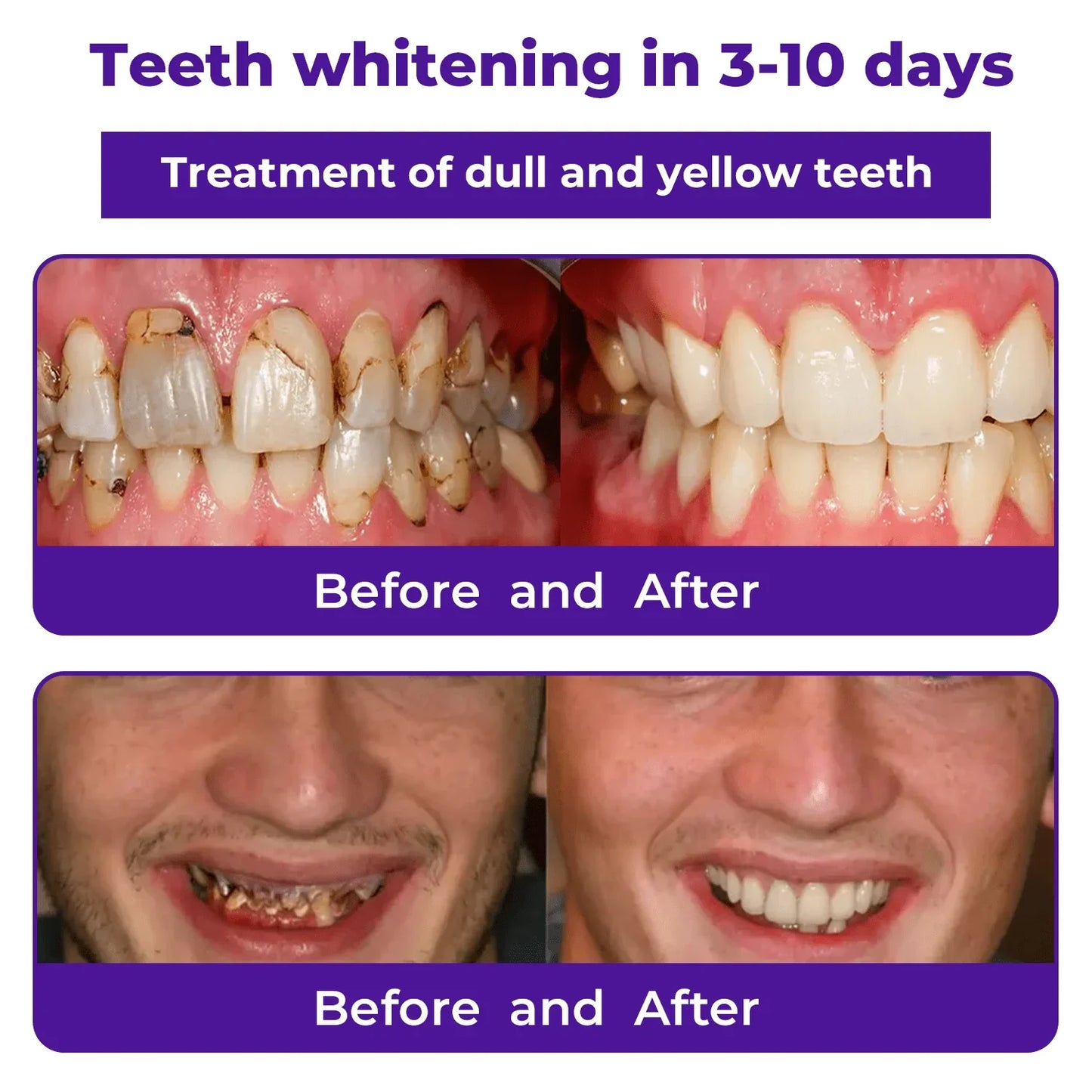 Cvreoz® Teeth Restoration Mineral Powder 🦷✨ Treats periodontitis & mouth ulcers, whitens teeth, prevents tooth loss, and repairs gum recession 😁