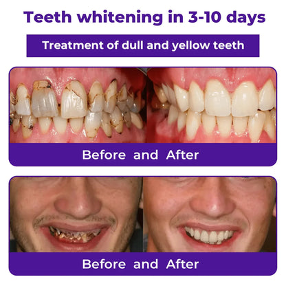 Cvreoz® Teeth Restoration Mineral Powder 🦷✨ Treats periodontitis & mouth ulcers, whitens teeth, prevents tooth loss, and repairs gum recession 😁