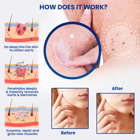 ⏰Last Day Promotion: 80% OFF🔥 Cvreoz® WartsOff Instant Blemish Removal Cream